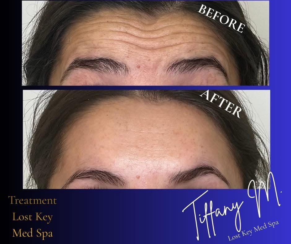 Before and after result