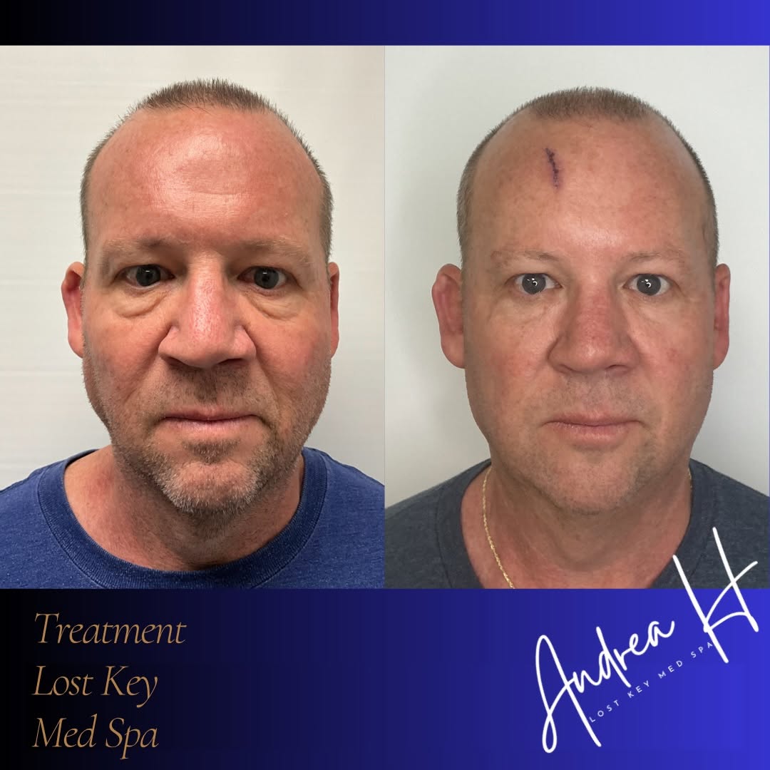 Before and after result
