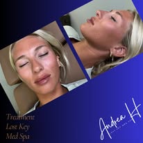 Lip filler before and after
