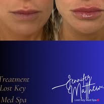 Lip filler before and after