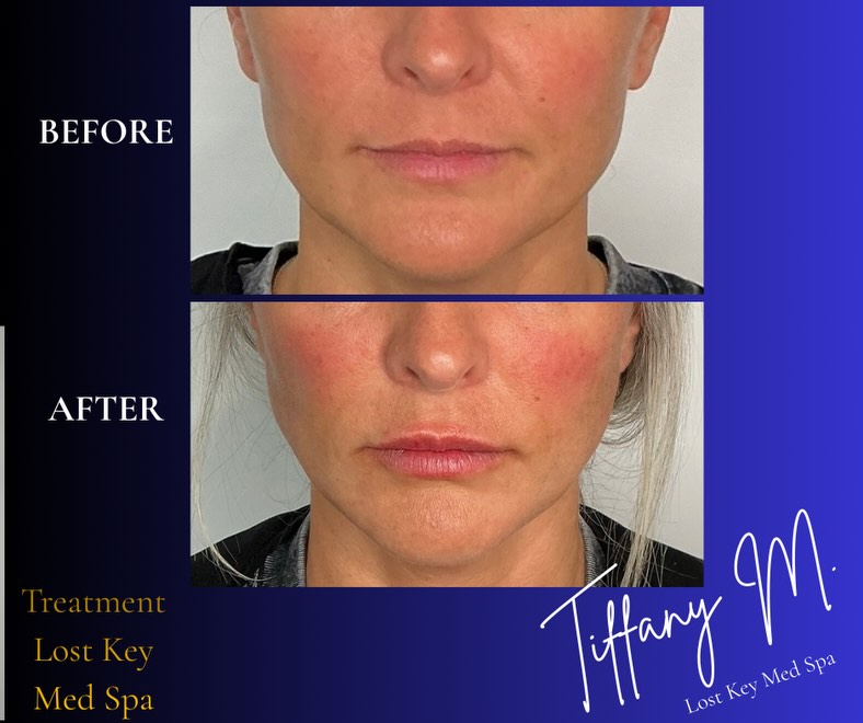 Lip filler before and after