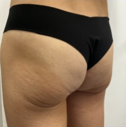 Non-surgical Brazilian Butt Lift Pensacola FL