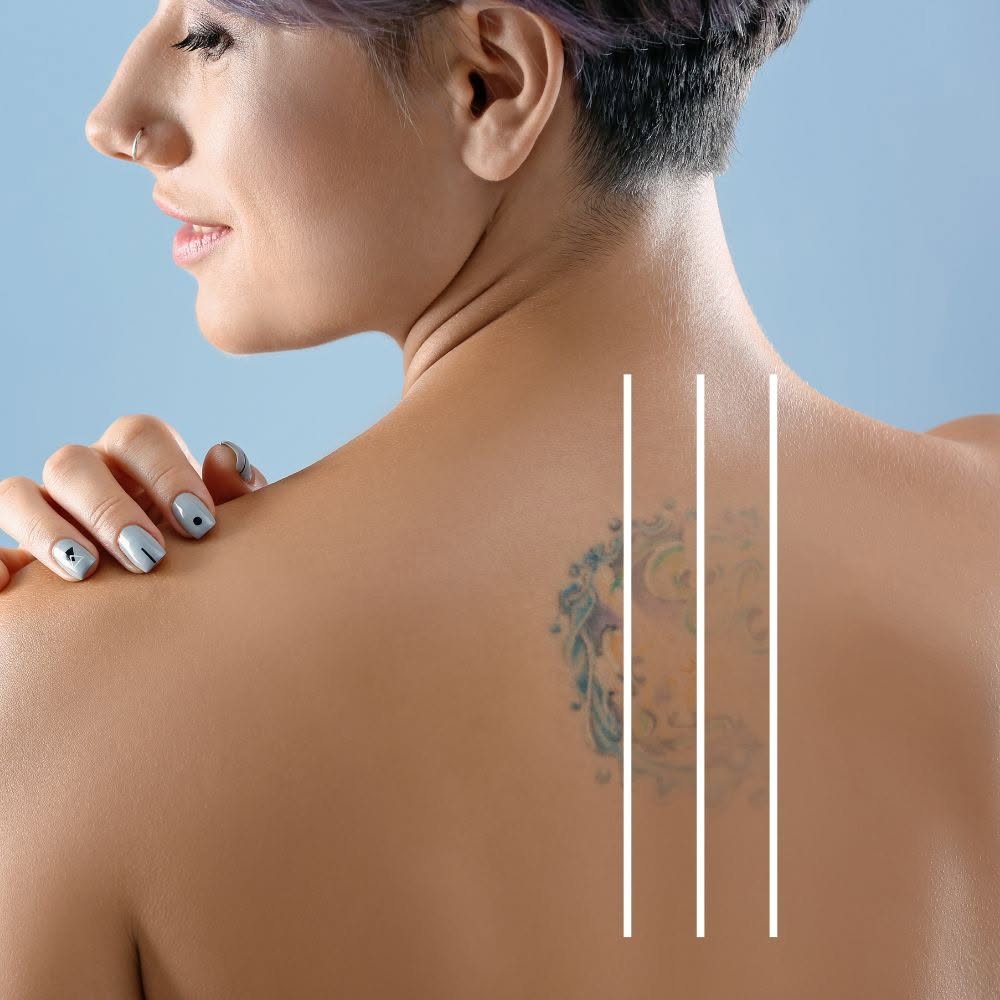 Tattoo removal candidate Pensacola FL